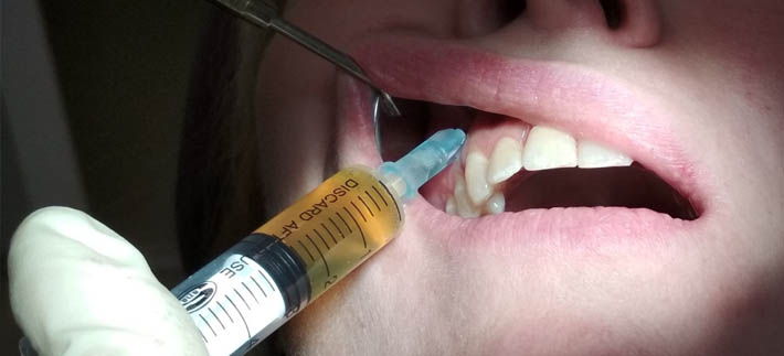 Использование плазмы крови в стоматологии