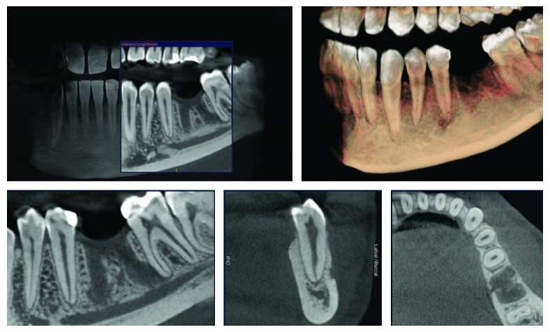 3D рентген зубов